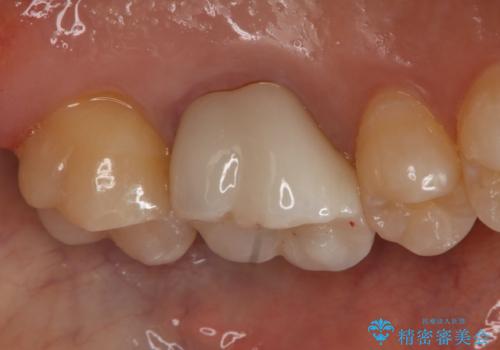 銀歯を白くしたい セラミックインレーの治療後