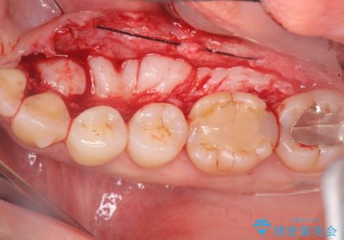 話すのに邪魔な、下顎骨隆起の切除の治療中