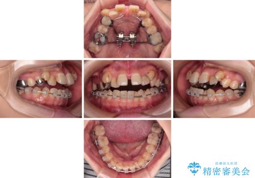 むし歯と八重歯を治したい 総合歯科治療の治療中