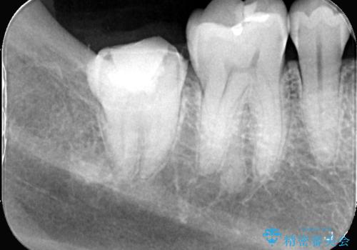 神経を残す治療|VPT|生活歯髄療法|オールセラミッククラウン|神経を残しながらクロスバイトの改善!の治療中