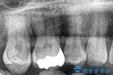 セラミックインレー 虫歯の治療の治療前