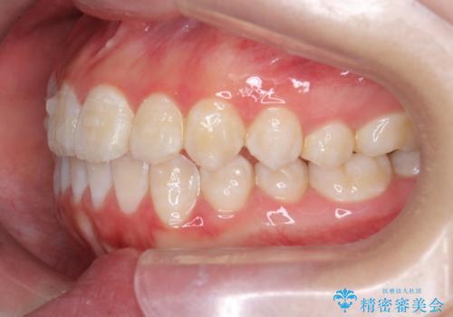 上下すれ違った前歯の矯正治療の治療中