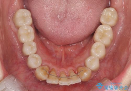 歯周病 、インプラント、 矯正 全顎治療の治療後