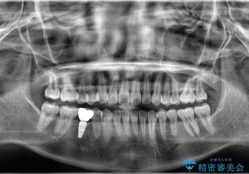 右下5番の先天欠如と前歯の叢生に対するワイヤー矯正とインプラント治療の治療後