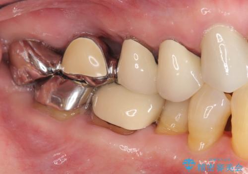 ブリッジのぐらつき インプラントを用いた奥歯の噛み合わせの再構築の治療前