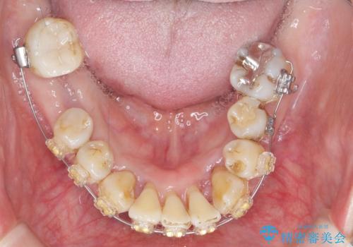 歯周病 、インプラント、 矯正 全顎治療の治療中