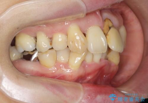 歯周病 、インプラント、 矯正 全顎治療の治療前