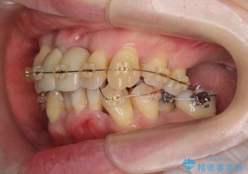 歯周病 、インプラント、 矯正 全顎治療の治療中