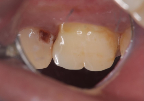 【セラミックインレー】ホワイトニングしに来たら虫歯が見つかったの治療前
