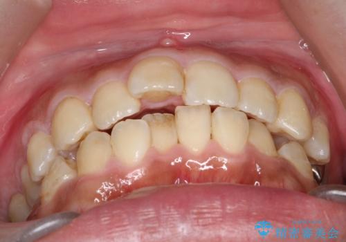 【ワイヤー矯正】前歯の凸凹を治したいの治療前