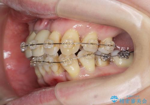 歯周病 、インプラント、 矯正 全顎治療の治療中