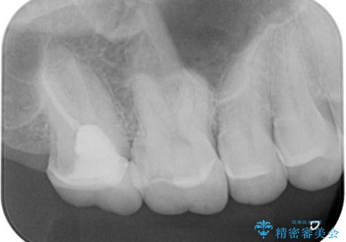 被せものが欠けた オールセラミッククラウンの治療前