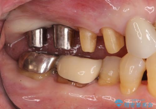 ブリッジのぐらつき インプラントを用いた奥歯の噛み合わせの再構築の治療中