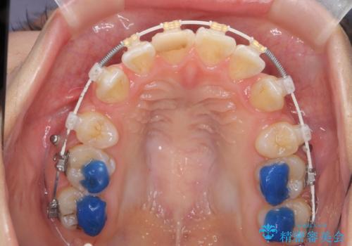 突き出た前歯を治したい　小臼歯抜歯+マルチブラケット矯正の治療中