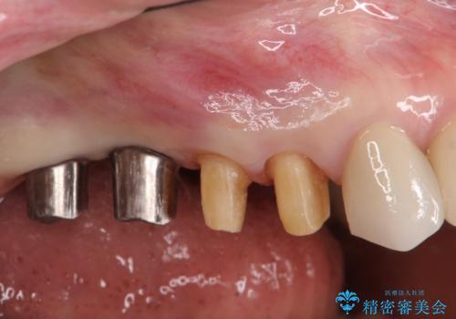 ブリッジのぐらつき インプラントを用いた奥歯の噛み合わせの再構築の治療中