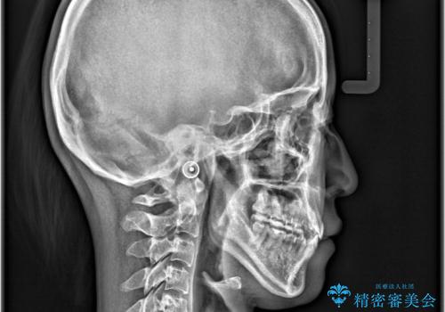 MARPEで非抜歯矯正|オープンバイトと八重歯を改善の治療後