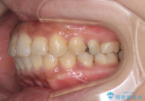 【ワイヤー矯正】前歯の凸凹を治したいの治療後