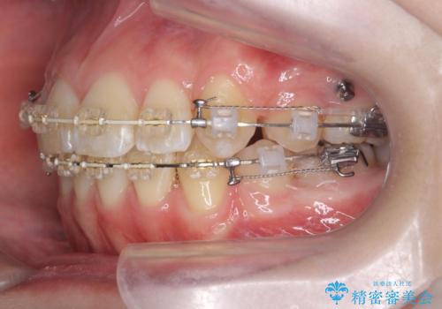 突き出た前歯を治したい 小臼歯抜歯+マルチブラケット矯正の治療中