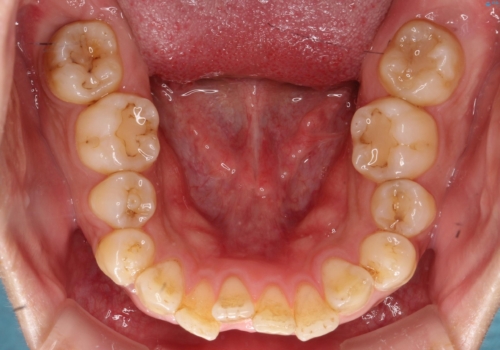 【ワイヤー矯正】前歯の凸凹を治したいの治療前