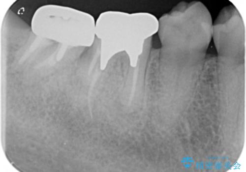 スペース狭小な銀歯を白くしたい 歯冠長延長術を併用したセラミック治療の治療前