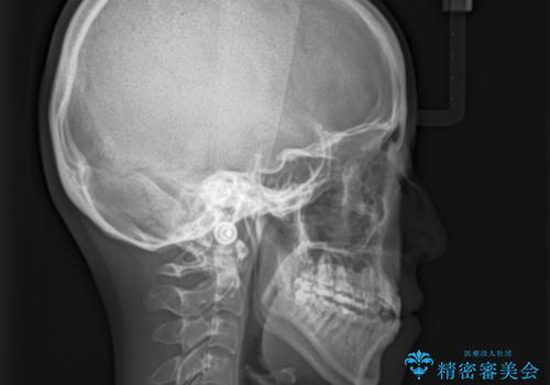 MARPEで非抜歯矯正|オープンバイトと八重歯を改善の治療前