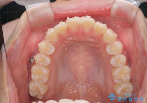 上下すれ違った前歯の矯正治療の治療中