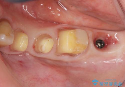 歯周病再生治療と歯周ポケット除去 歯周外科手術の治療中