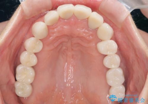 全顎 虫歯 インプラント治療の治療後