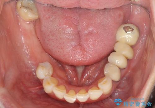 全顎 虫歯 インプラント治療の治療前