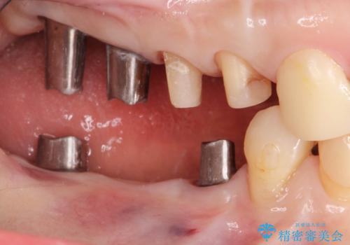 全顎 虫歯 インプラント治療の治療中