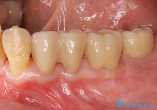 歯周病再生治療と歯周ポケット除去  歯周外科手術の症例 治療後