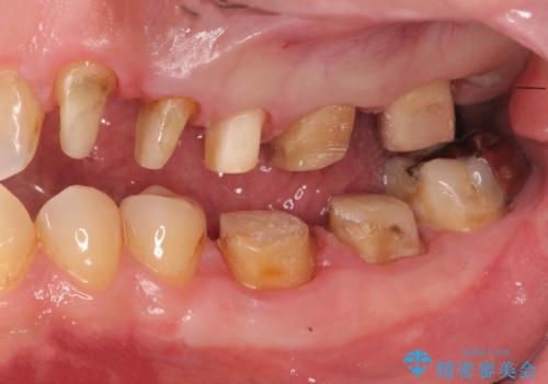 銀歯・虫歯・治療途中の歯を治していきたいの治療中