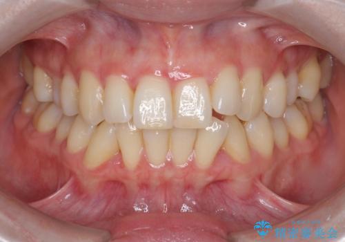非抜歯(歯を抜かない)の症例 治療前