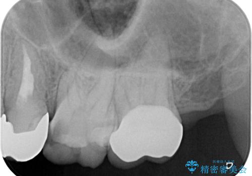 プラスチックの詰め物が外れた オールセラミッククラウンの治療前