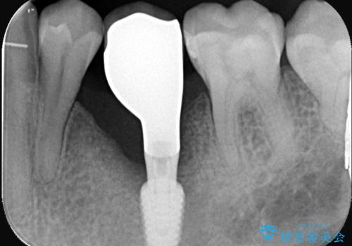 20年前にいれたインプラント|インプラント周囲炎|古いインプラントを除去しインプラント再埋入|痛く無いインプラント治療の治療後