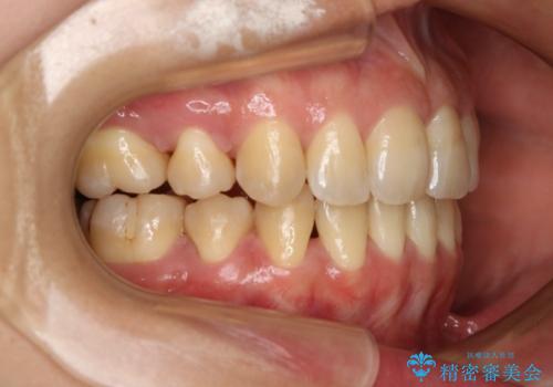 前歯を後ろに下げたい ワイヤー矯正(クリア装置)の治療後