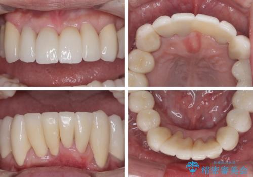 歯周病でグラグラの歯 矯正治療と歯周外科を併用した総合歯科治療の治療後