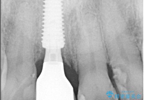 折れた前歯を即時インプラントで回復の治療後