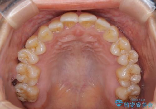 前歯を後ろに下げたい ワイヤー矯正(クリア装置)の治療前