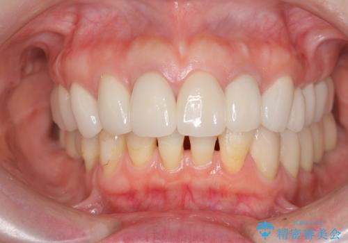 全顎 虫歯 インプラント治療の症例 治療後