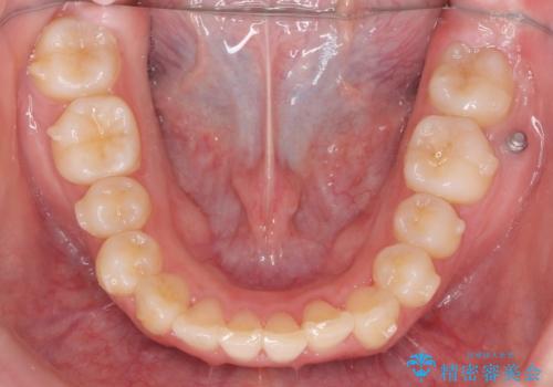 前歯のズレ・がたつき・すれ違いの矯正治療の治療中