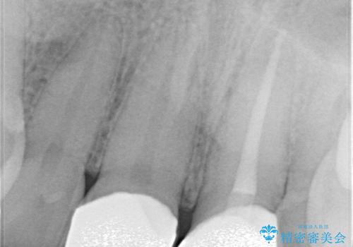 前歯の根のところに違和感がある|根尖性歯周炎|精密根管治療|オールセラミッククラウン|見た目も改善の治療後