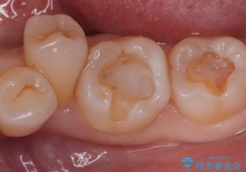 【セラミックインレー】口の中の銀の詰め物を白い物に替えたいの治療中