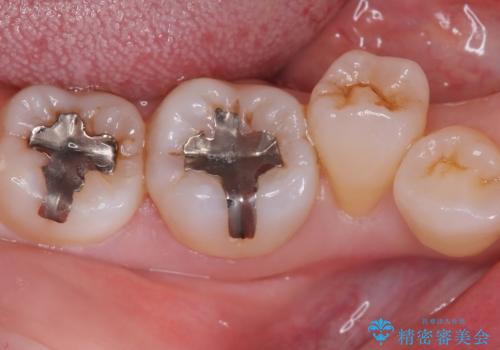【セラミックインレー】口の中の銀の詰め物を白い物に替えたいの治療前