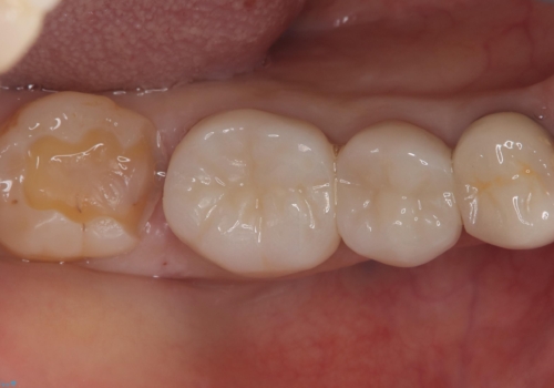 【セラミックインレー】笑うと銀の詰め物が目立つの治療中