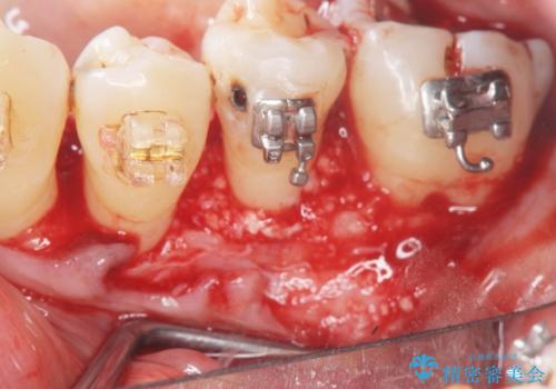 歯周病再生治療と歯周ポケット除去 歯周外科手術の治療前