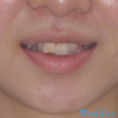 転位歯や埋伏歯などの難易度の高い抜歯矯正治療の治療前(顔貌)