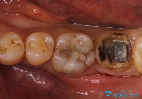 割れた奥歯をセラミックで修復