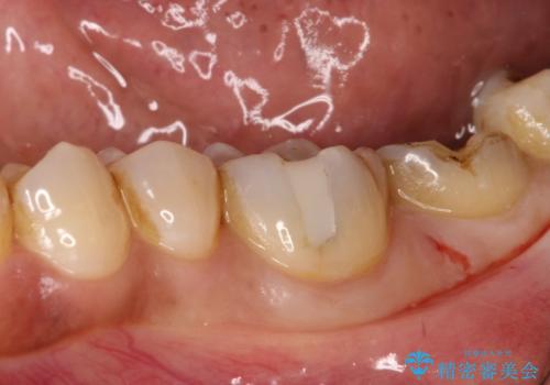 割れた奥歯をセラミックで修復の治療前