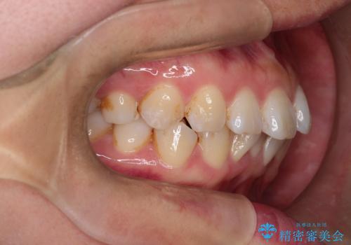 マウスピースで歯並びと正中を改善の治療前
